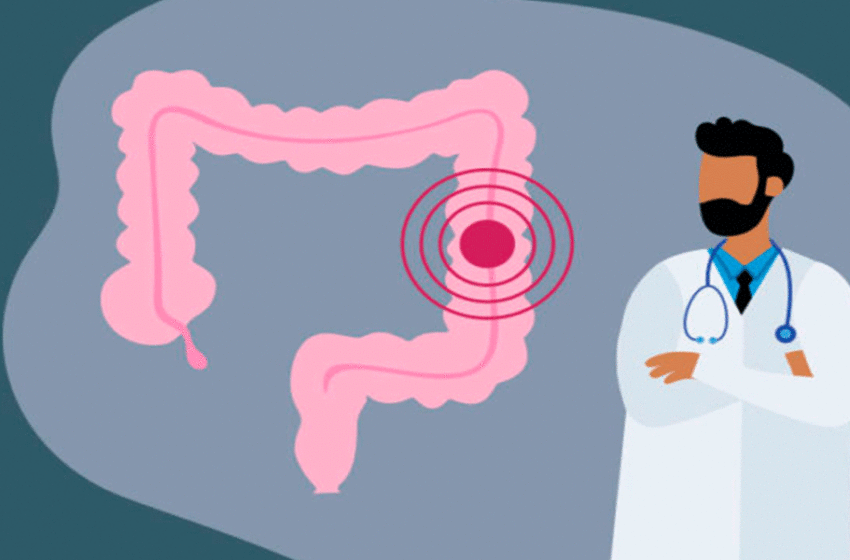  SEIS consejos para prevenir el cáncer colorrectal