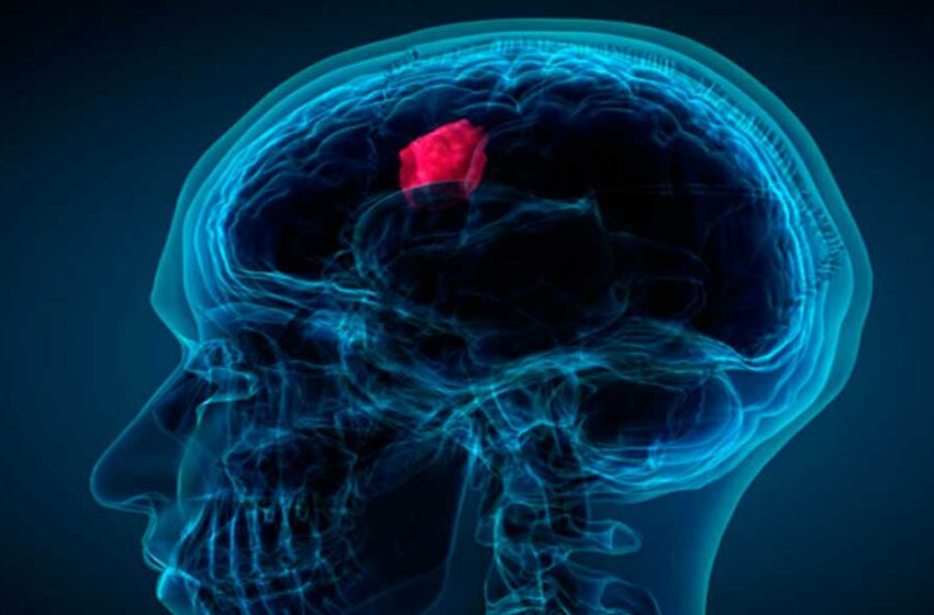  ¿Cuáles son las señales de advertencia reales de un tumor cerebral?