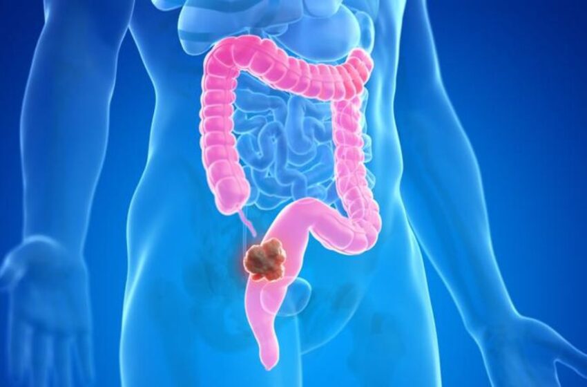  «DIVCOM presenta innovador test para detección de cáncer de colon con alta efectividad»