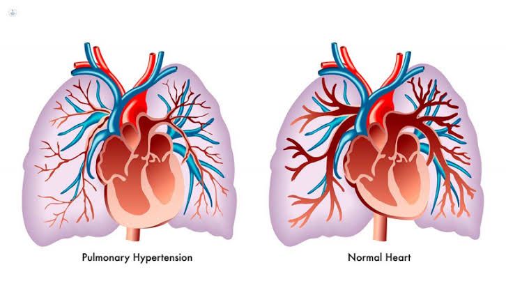  Essalud pone en riesgo la salud y la vida de los pacientes con hipertensión pulmonar