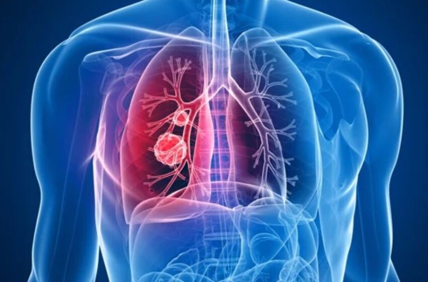  El diagnóstico temprano y los avances significativos en el tratamiento podrían reducir la alta tasa de mortalidad de cáncer de pulmón