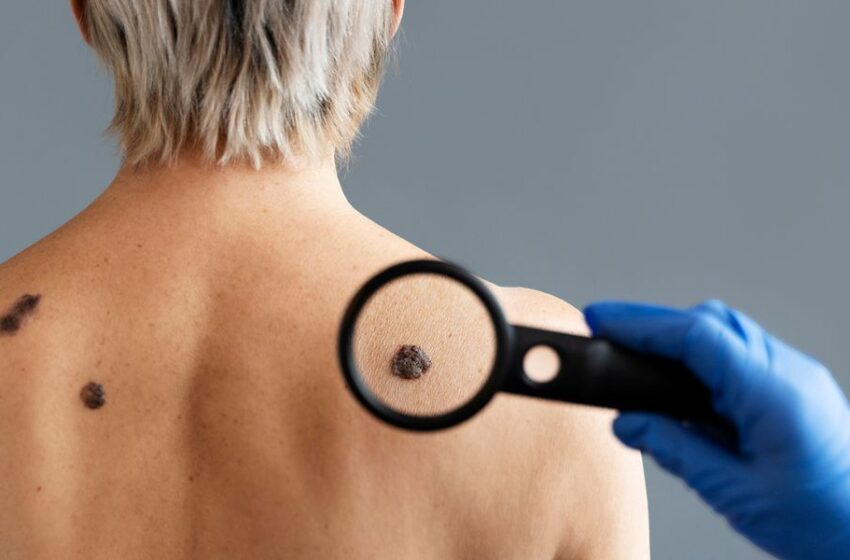  ¿Cómo prevenir el cáncer de piel con la identificación temprana de melanoma?