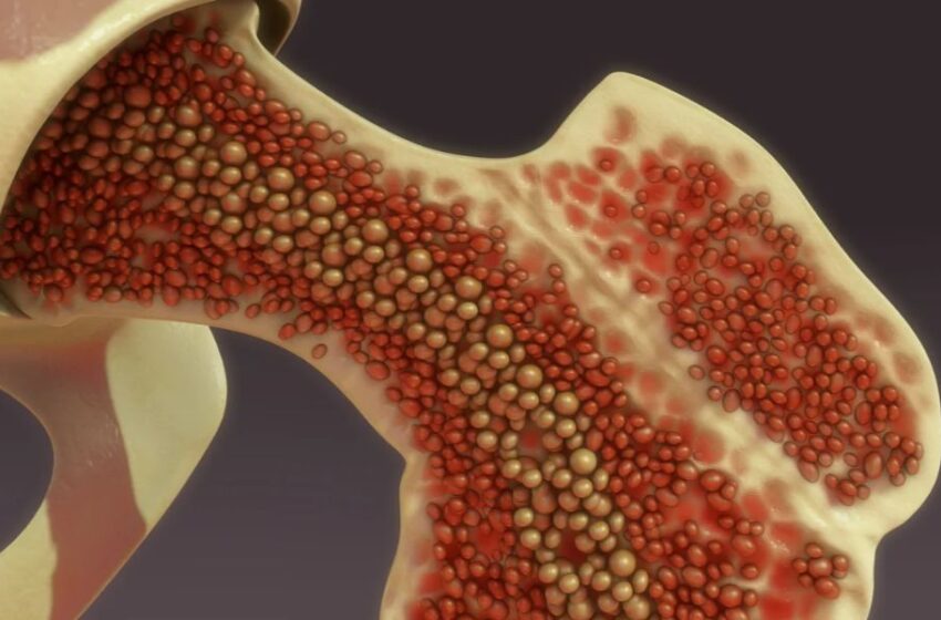  El significado vital del Trasplante de Médula Ósea