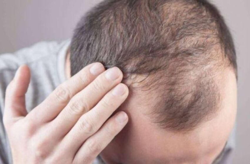  Caída del cabello: Como recuperarlo de manera rápida y segura