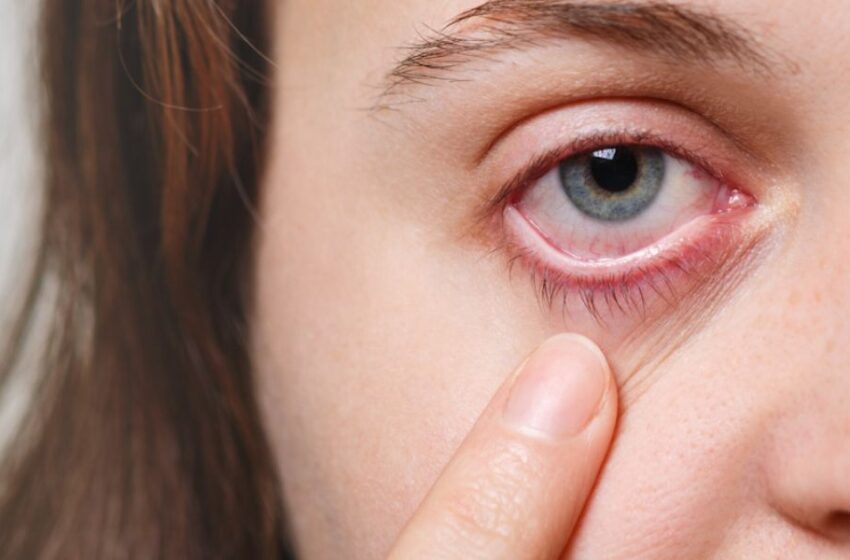  Conjuntivitis en verano: ¿Cómo evitarla? Recomendaciones de un oftalmólogo