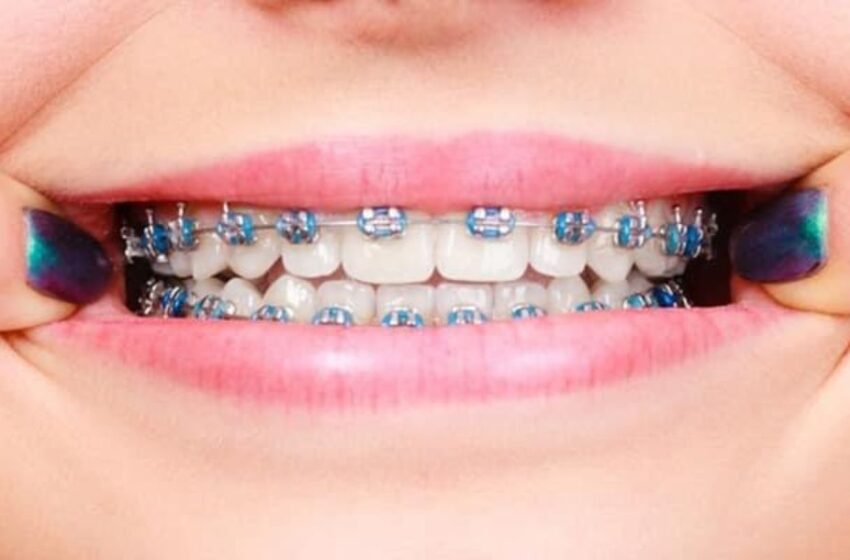  Brackets: ¡Todo lo que necesitas saber sobre estos aliados de tu sonrisa!