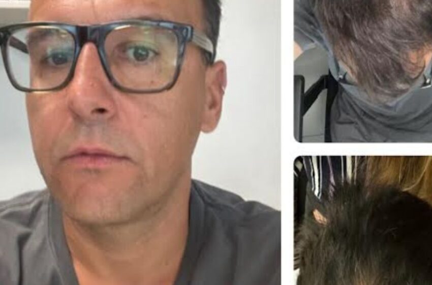  No invasivo y libre de químicos: Ingeniero probó innovador tratamiento contra la caída del cabello con impresionantes resultados 